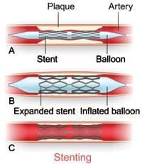 What Is Angioplasty? How It Opens Blocked Arteries